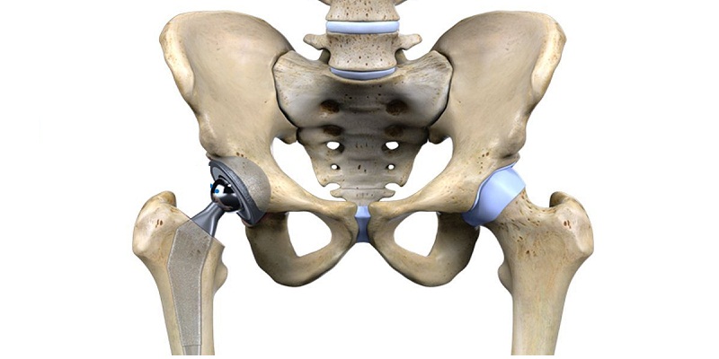 What All Complications are there in Total Hip Replacement?