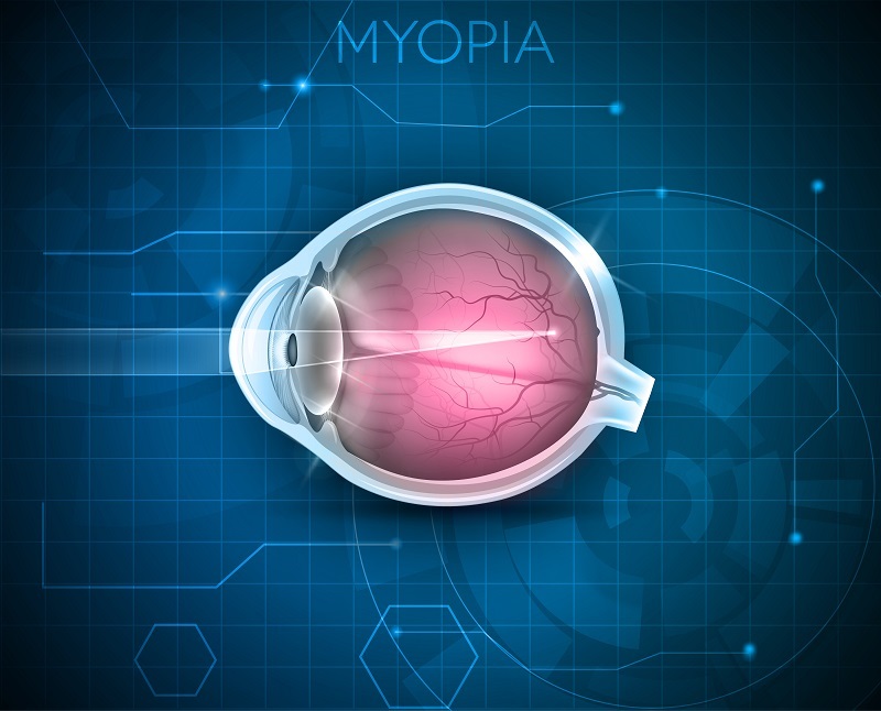 myopia control